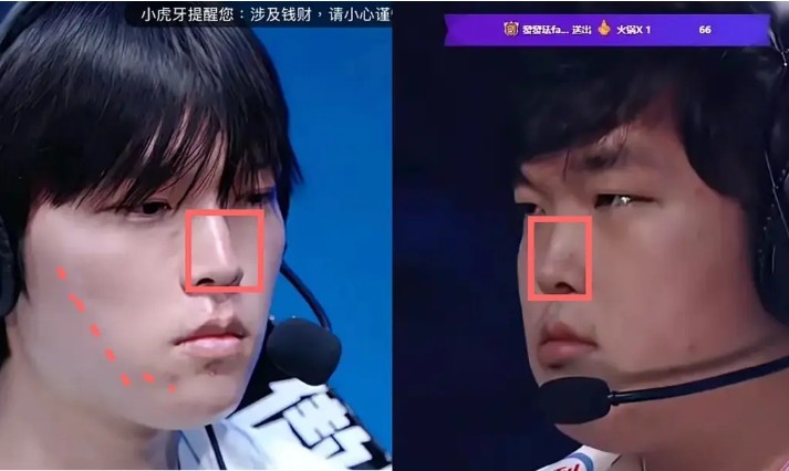【蜗牛电竞】网友细扒Bin脸部变化细节:鼻梁变直变长;脸颊软组织折叠变化